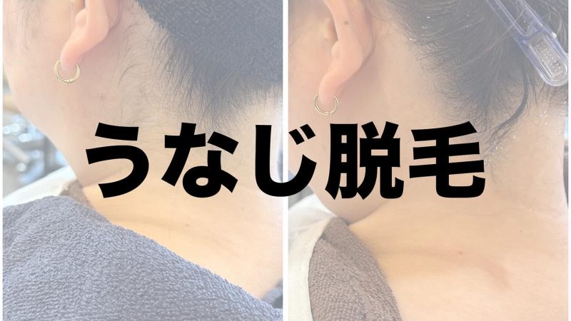 うなじ脱毛